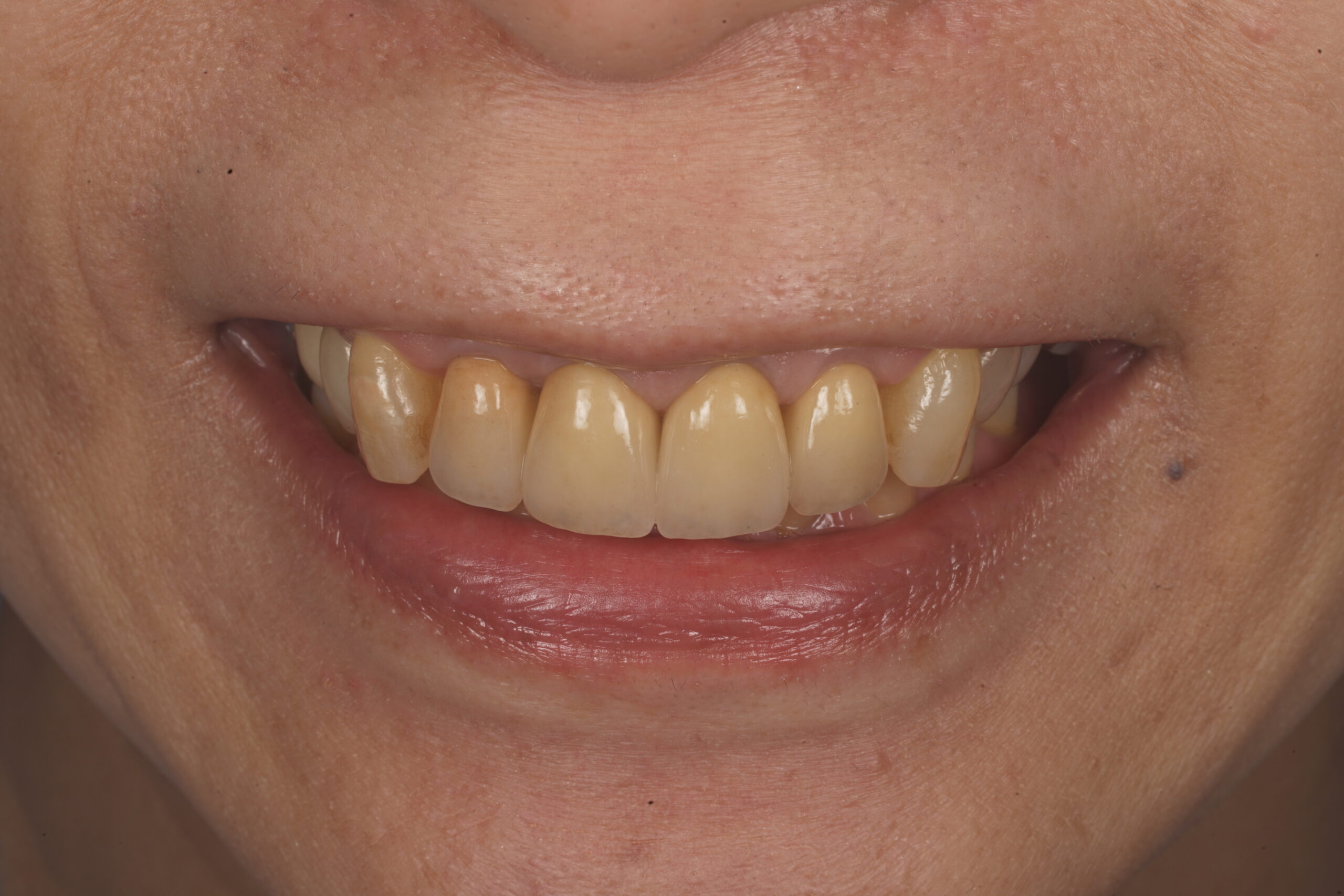 After image