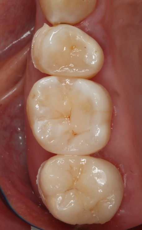 After image