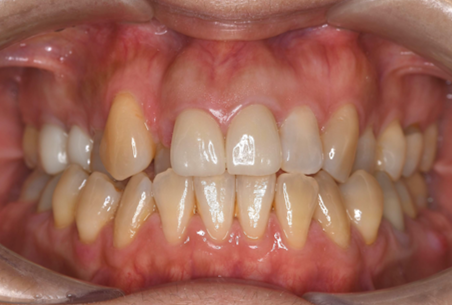 After image