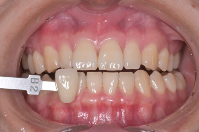 Before image