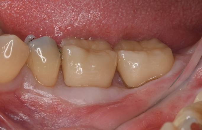 After image